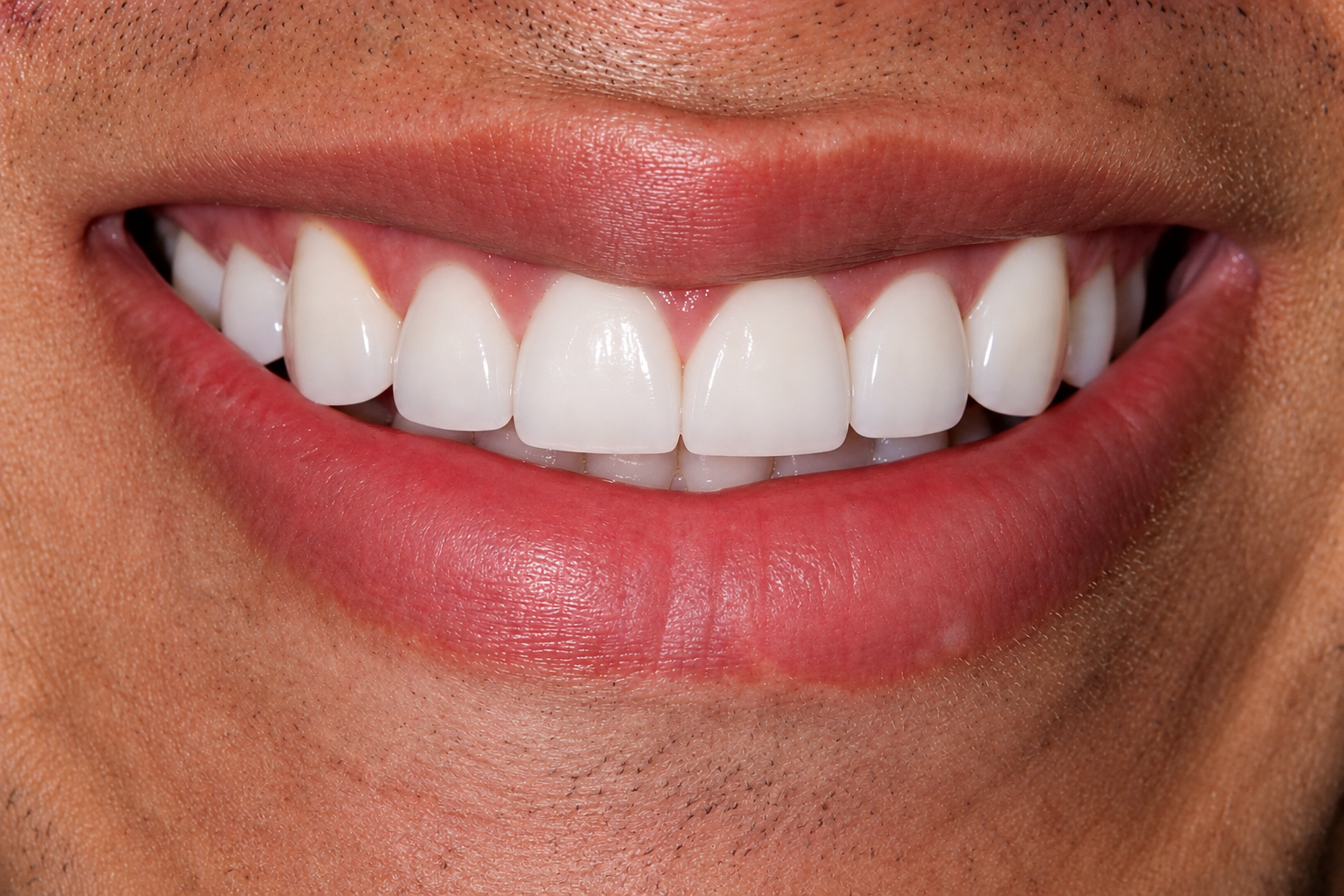 Before Treatment